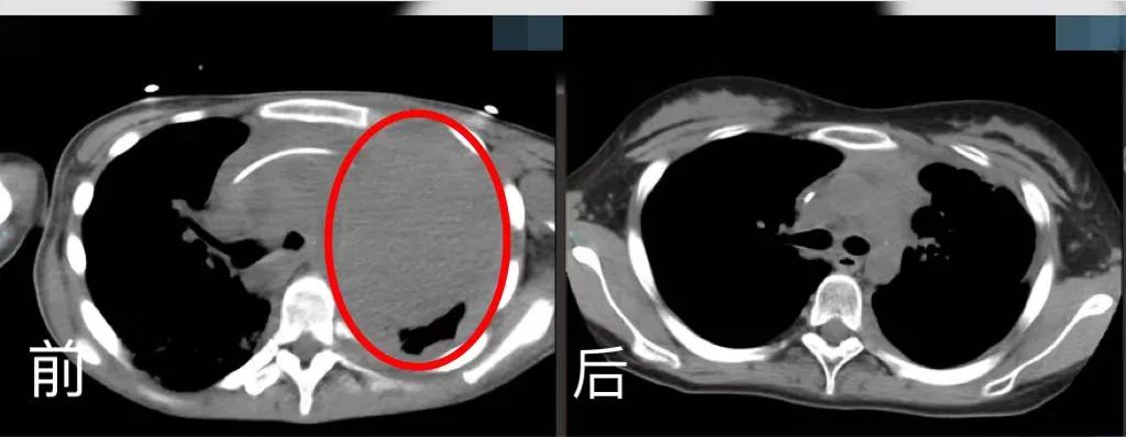 胸腔CT前后對比。四川省腫瘤醫(yī)院供圖