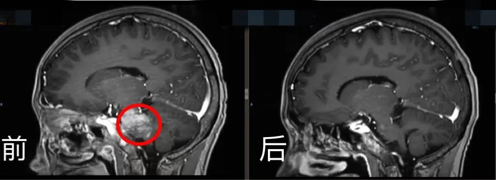 腦部CT前后對比。四川省腫瘤醫(yī)院供圖